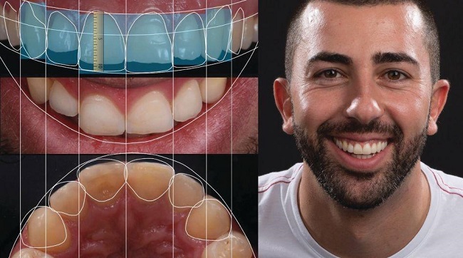 Digital Smile Design - Thiết kế nụ cười kỹ thuật số 