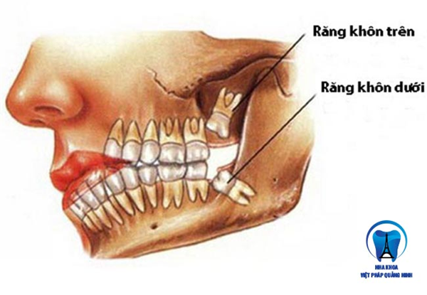 Nhổ răng số 8 có đau không? Những điều cần lưu ý khi nhổ răng số 8.