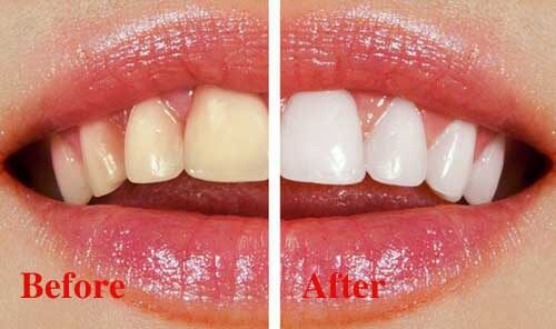 Quy trình tẩy trắng răng laser whitening tiêu chuẩn diễn ra thế nào?